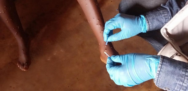 mpox1 Mpox : une dangerosité difficile à évaluer