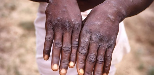 variole-singe Mpox : quels sont les pays africains touchés par la variole du singe ?