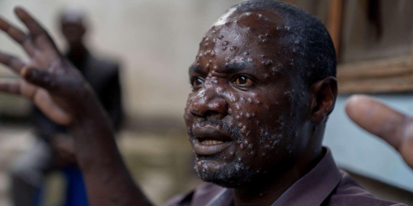 virus Virus Mpox : ce que l’on sait de cette épidémie qui s’accélère en Afrique